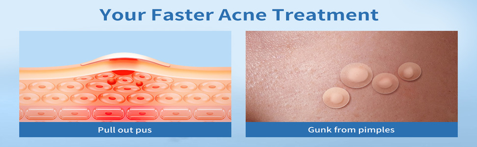 Reliable-Arc-108-PCS-Hydrocolloiod-Pimple-Patches-With-Tree-